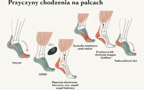 Ilustracja pokazuje, dlaczego dziecko chodzi na palcach: autyzm, ADHD, dystrofia mięśniowa, przykurcz ścięgna Achillesa, nadwrażliwość dotykowa.