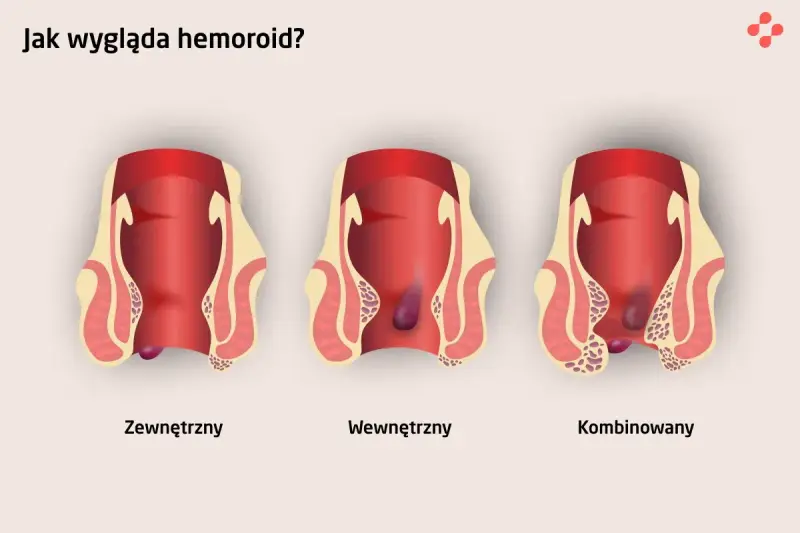 Ilustracja pokazuje trzy rodzaje hemoroidów: zewnętrzny, wewnętrzny i kombinowany. Choć hemoroidy u dzieci są rzadkie, mogą wystąpić.